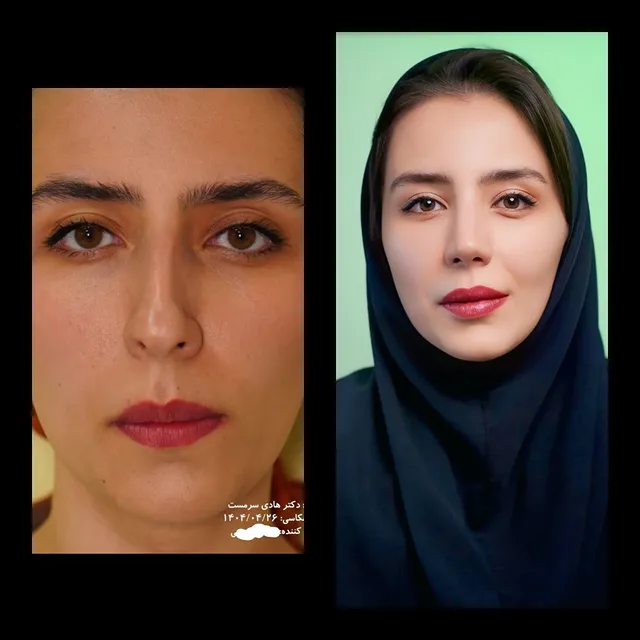 نمونه کار جراحی بینی دکتر هادی سرمست شماره 01