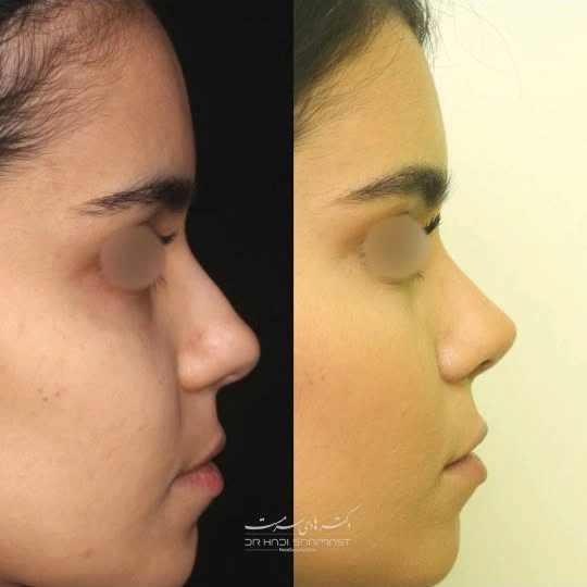 نمونه کار جراحی بینی دکتر هادی سرمست شماره 03