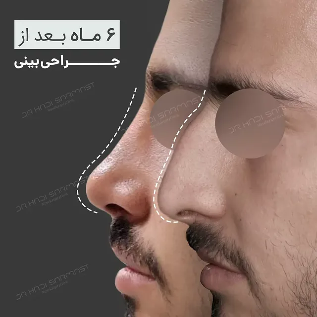 نمونه کار جراحی بینی دکتر هادی سرمست شماره 04
