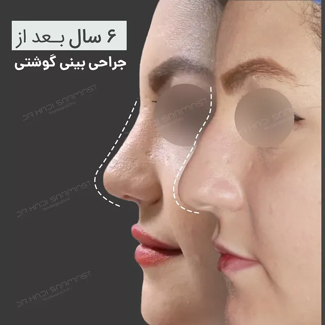 نمونه کار جراحی بینی دکتر هادی سرمست شماره 05