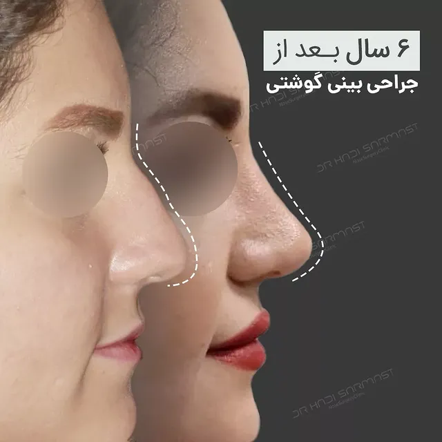 نمونه کار جراحی بینی دکتر هادی سرمست شماره 06