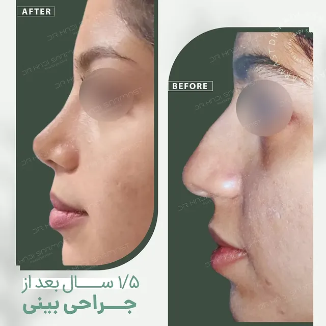 نمونه کار جراحی بینی دکتر هادی سرمست شماره 07