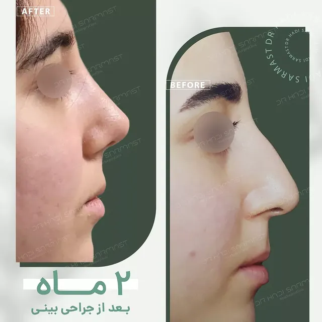 نمونه کار جراحی بینی دکتر هادی سرمست شماره 08