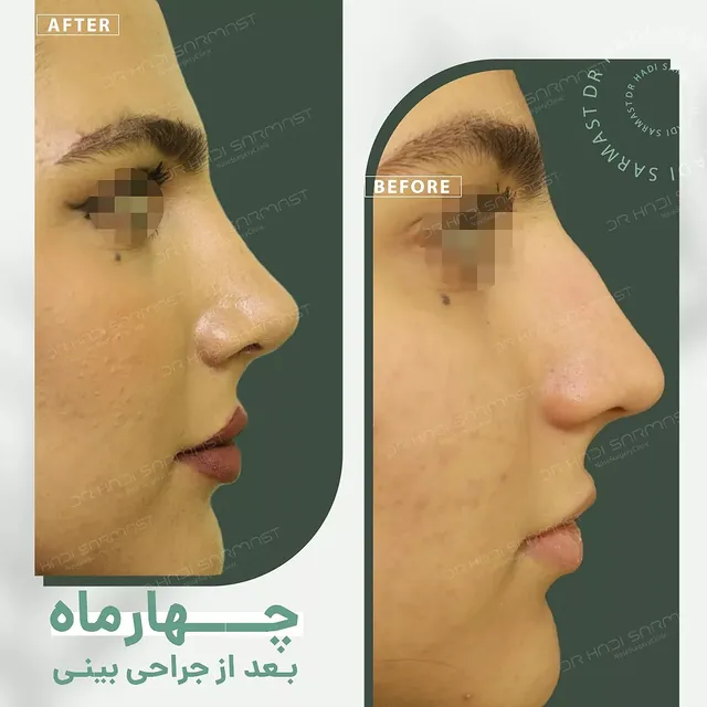 نمونه کار جراحی بینی دکتر هادی سرمست شماره 09