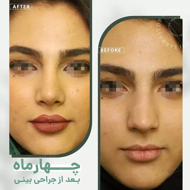 نمونه کار جراحی بینی دکتر هادی سرمست شماره 10
