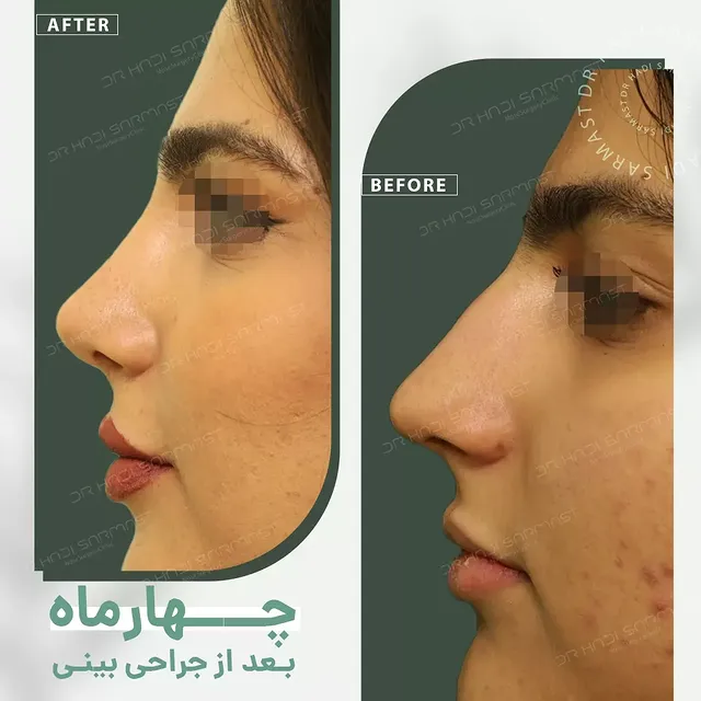نمونه کار جراحی بینی دکتر هادی سرمست شماره 11