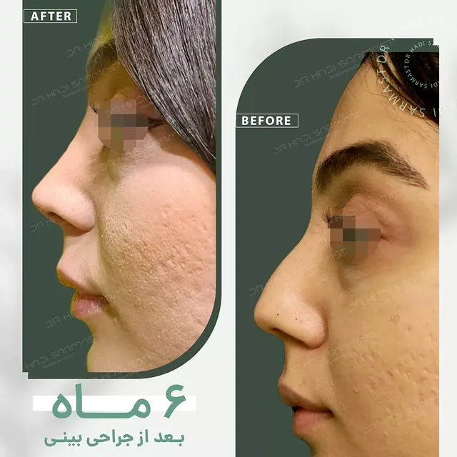 نمونه کار جراحی بینی دکتر هادی سرمست شماره 12