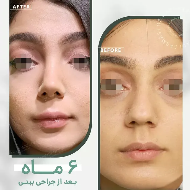 نمونه کار جراحی بینی دکتر هادی سرمست شماره 13