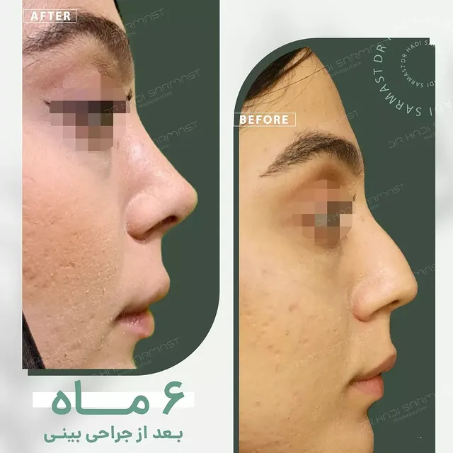 نمونه کار جراحی بینی دکتر هادی سرمست شماره 14