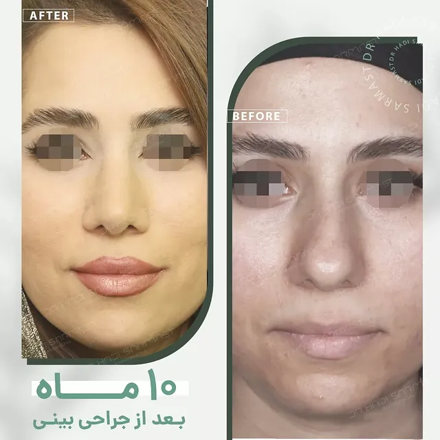 نمونه کار جراحی بینی دکتر هادی سرمست شماره 15