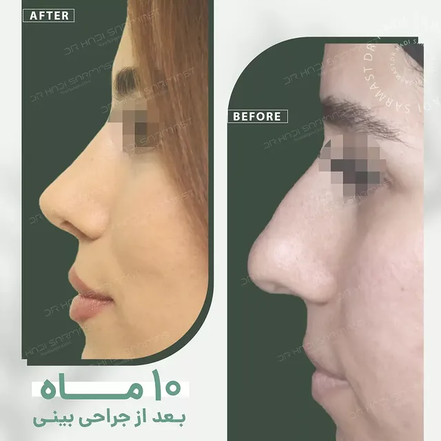 نمونه کار جراحی بینی دکتر هادی سرمست شماره 16